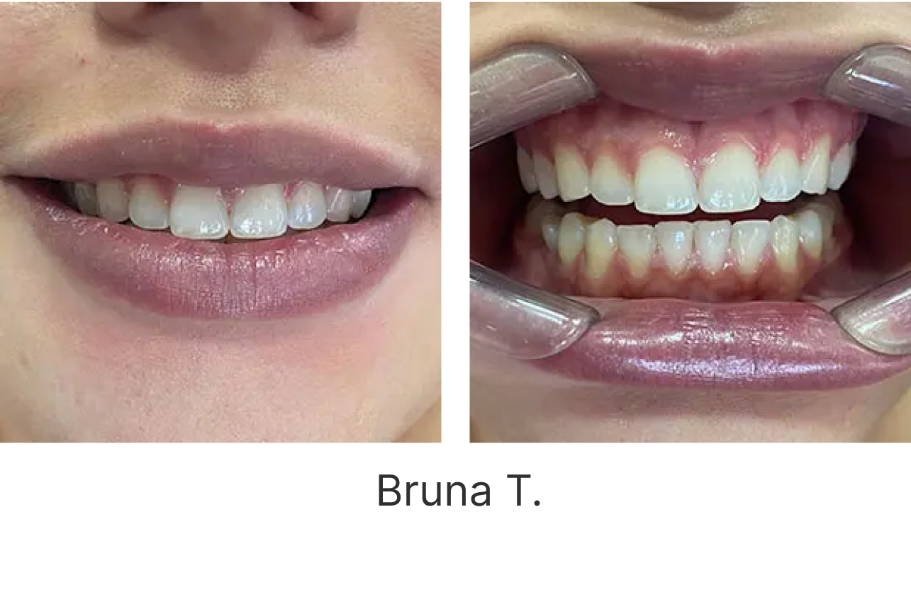 LP Aparelhos Invisíveis Medicina Dentária no Porto