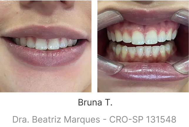 lp-smile-aparelho-transparente