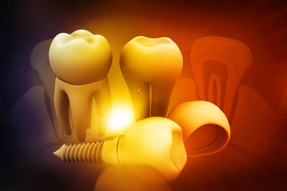Implantes Dentarios Smilemoreportugal