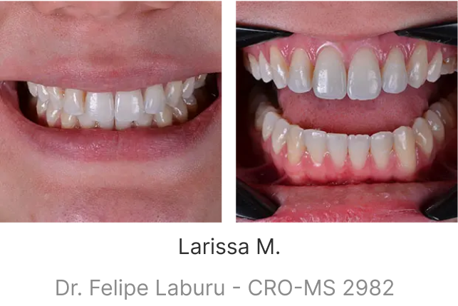 lp-smile-aparelho-transparente