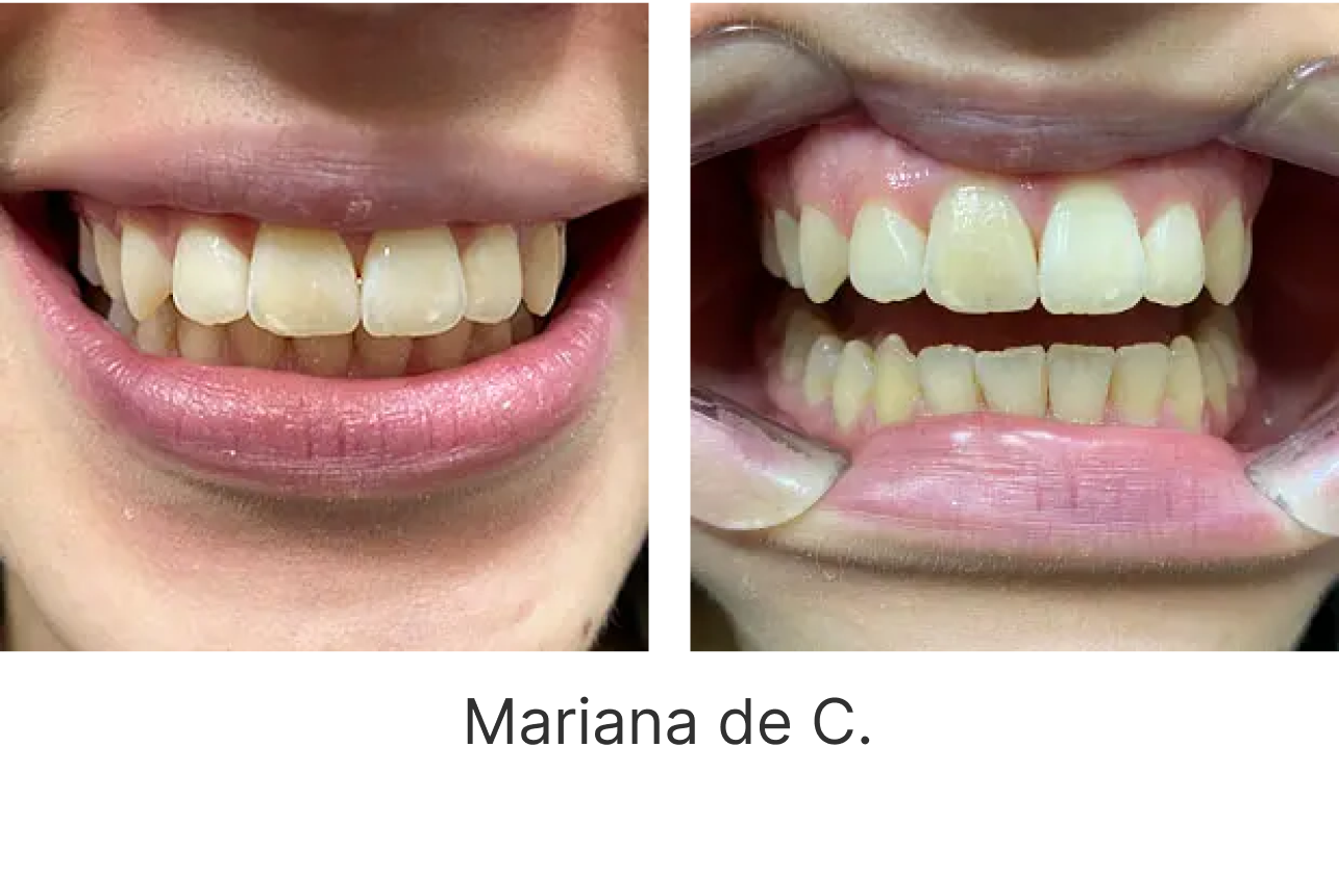 LP Aparelhos Invisíveis Medicina Dentária no Porto