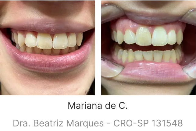 lp-smile-aparelho-transparente