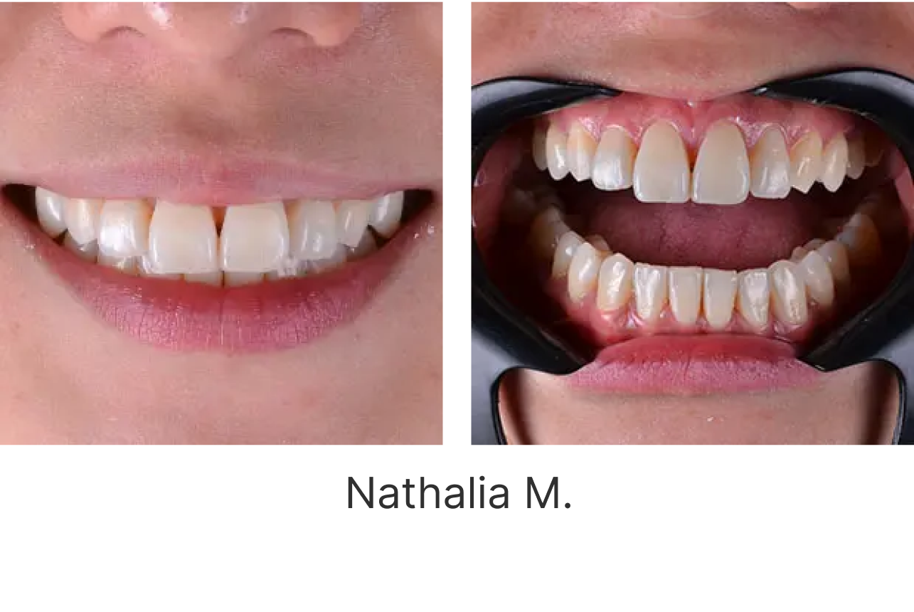 LP Aparelhos Invisíveis Medicina Dentária no Porto