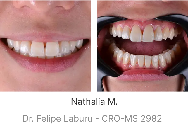 lp-smile-aparelho-transparente