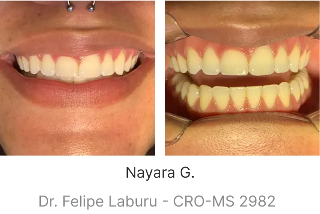 lp-smile-aparelho-transparente