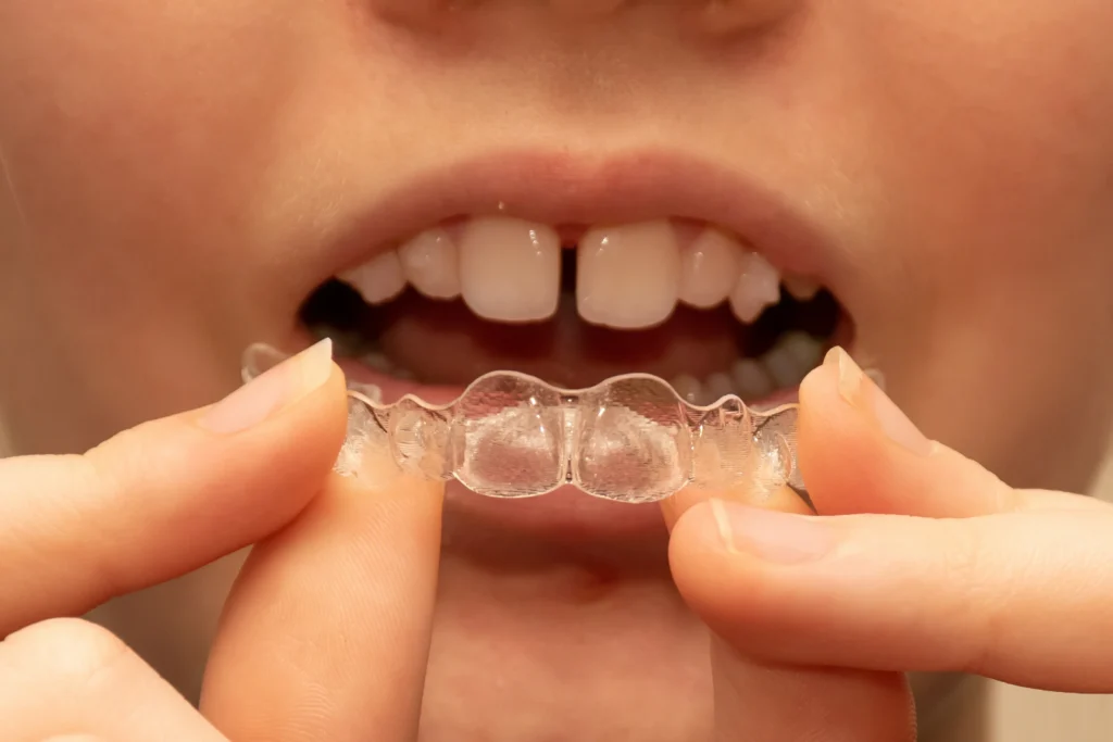 Smile More Clinica Dentaria Em Lisboa E Porto (2)