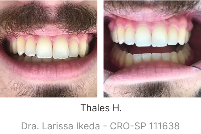 lp-smile-aparelho-transparente