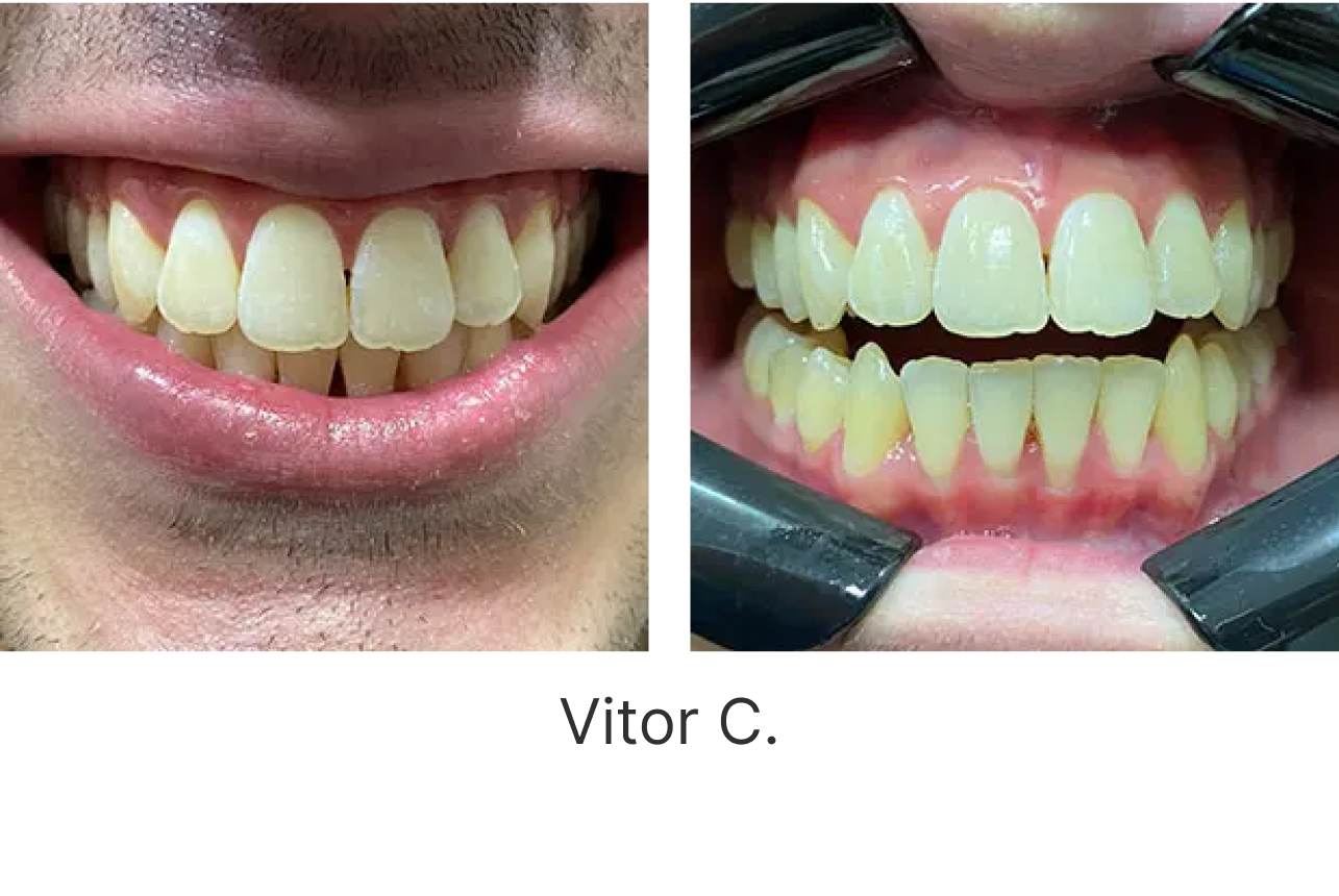 LP Aparelhos Invisíveis Medicina Dentária no Porto