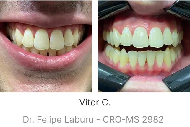 lp-smile-aparelho-transparente