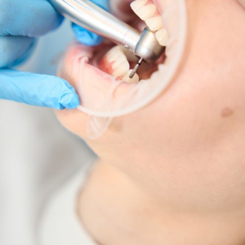 Como Desvitalizar Um Dente