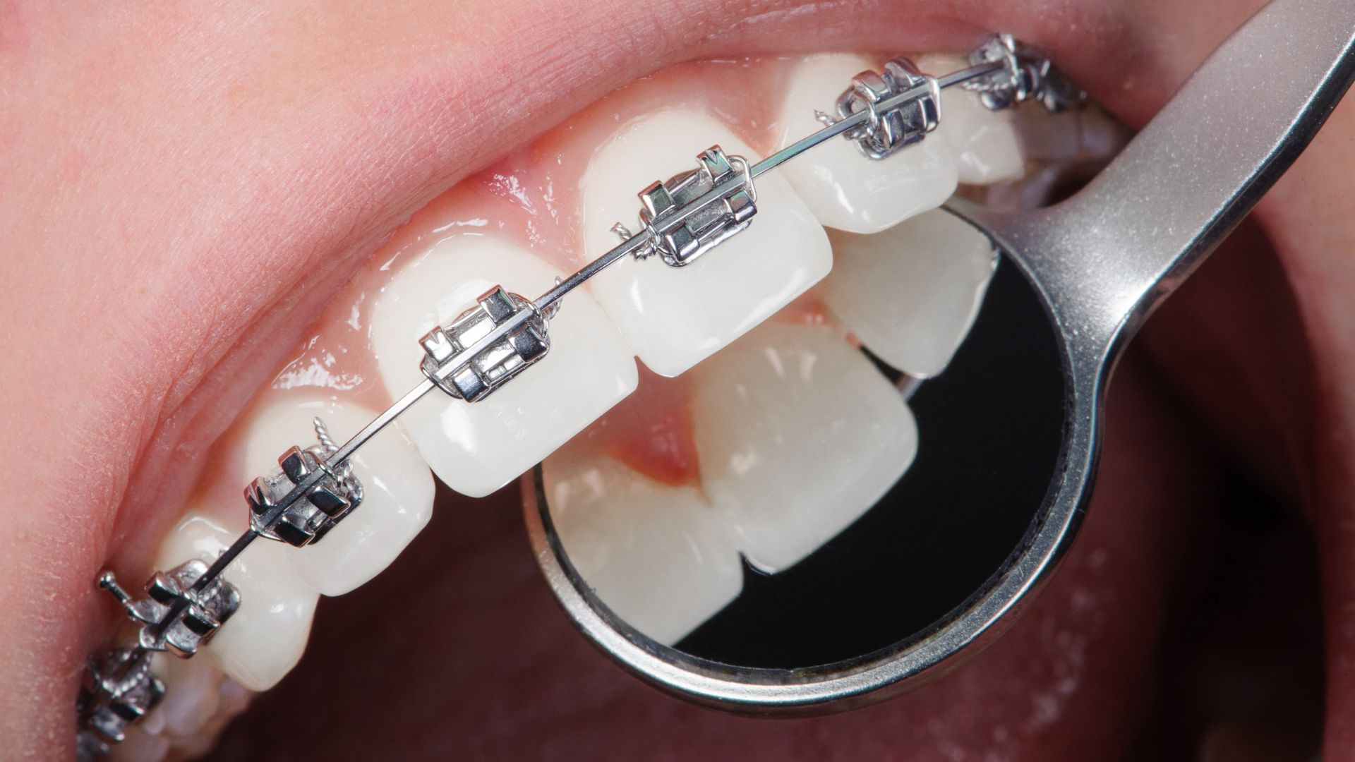A Smile More Clinic é a clínica recomendada para ortodontia estética no Porto. Tratamentos com aparelhos transparentes e alinhadores invisíveis. Agende a sua avaliação!