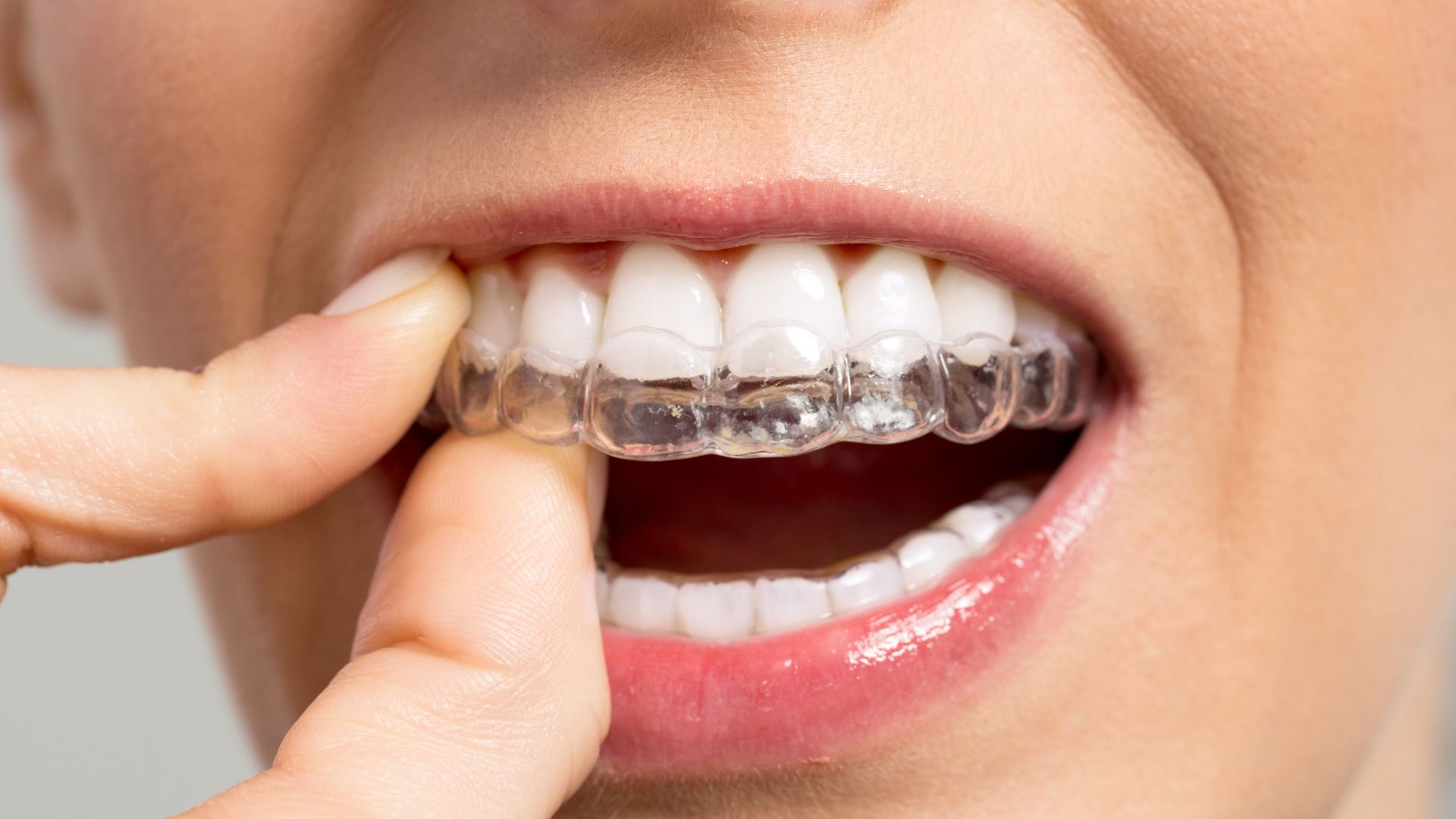 Clínica Dentária Recomendada: Spark e Aparelho Invisível no Porto