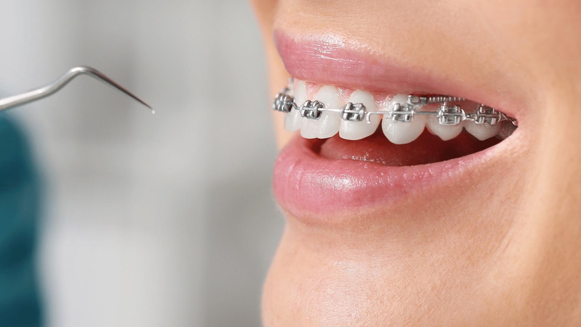 Descubra tudo sobre ortodontia com brackets metálicos no Porto. A Smile More oferece soluções eficazes para o seu sorriso.