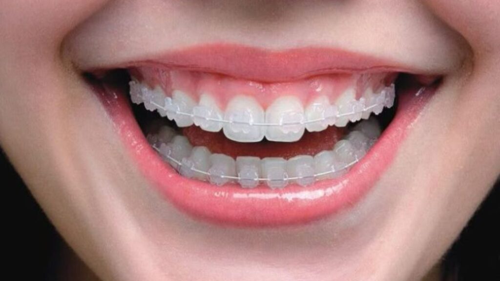 Descubra as diferenças entre o aparelho metálico tradicional e o autoligado. Saiba qual oferece tratamento mais rápido, maior conforto e melhor higiene na Smile More Clinic.