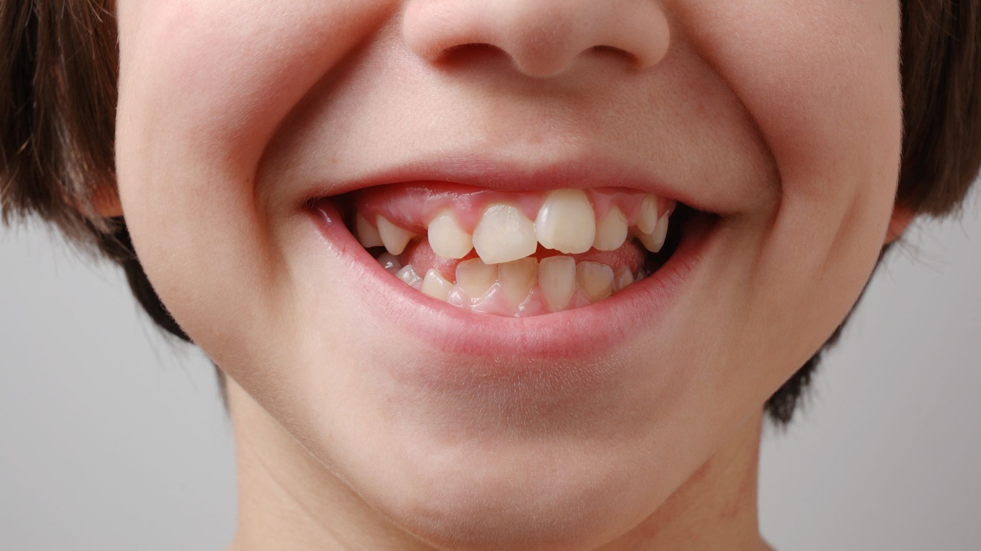 Descubra os riscos de não alinhar dentes tortos: cáries, desgaste excessivo e dores na ATM. Saiba como a Smile More Clinic ajuda a prevenir estes problemas de forma discreta.
