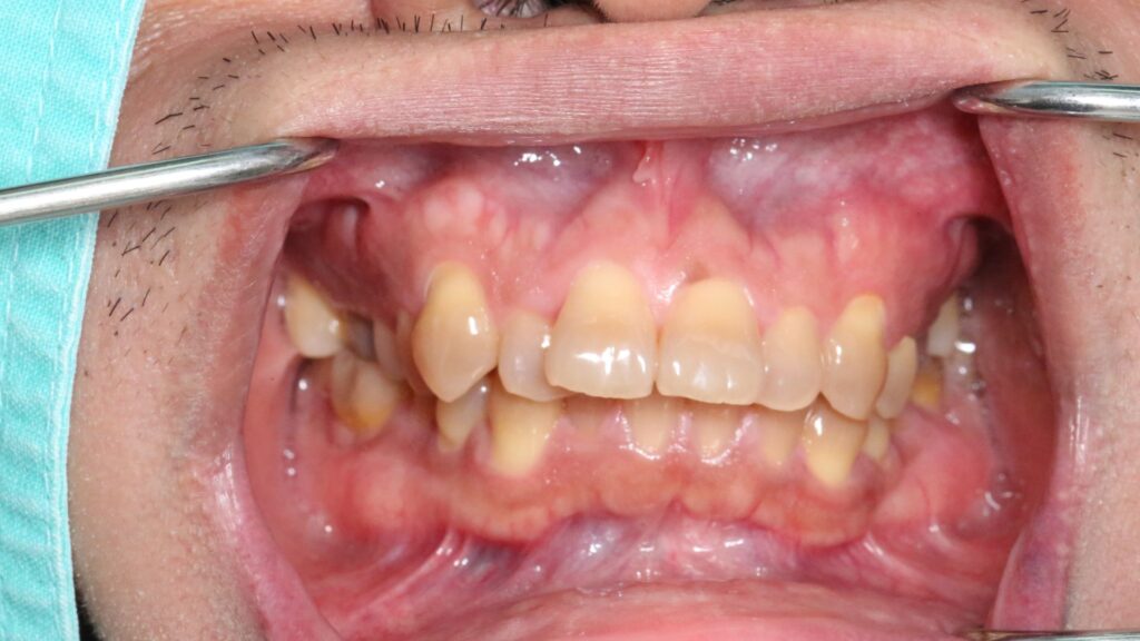Dentes desalinhados vão muito além da estética. Descubra como os dentes tortos podem causar cáries, dores de cabeça e perda óssea, e saiba como a Smile More Clinic pode ajudar.