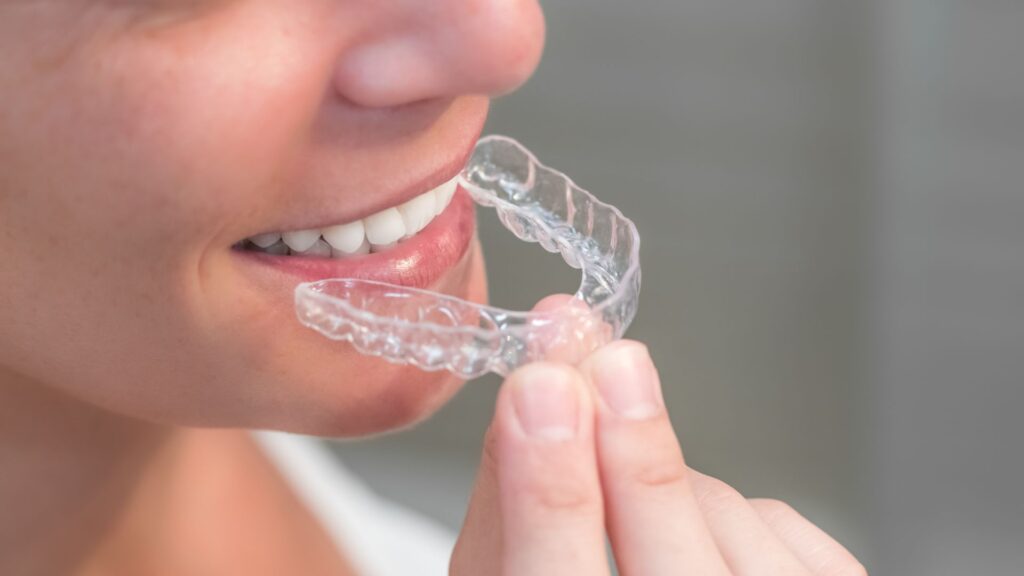 Descubra a diferença entre o aparelho dentário tradicional e o autoligado. Entenda como o fim das borrachinhas garante um tratamento mais rápido e confortável na Smile More Clinic.