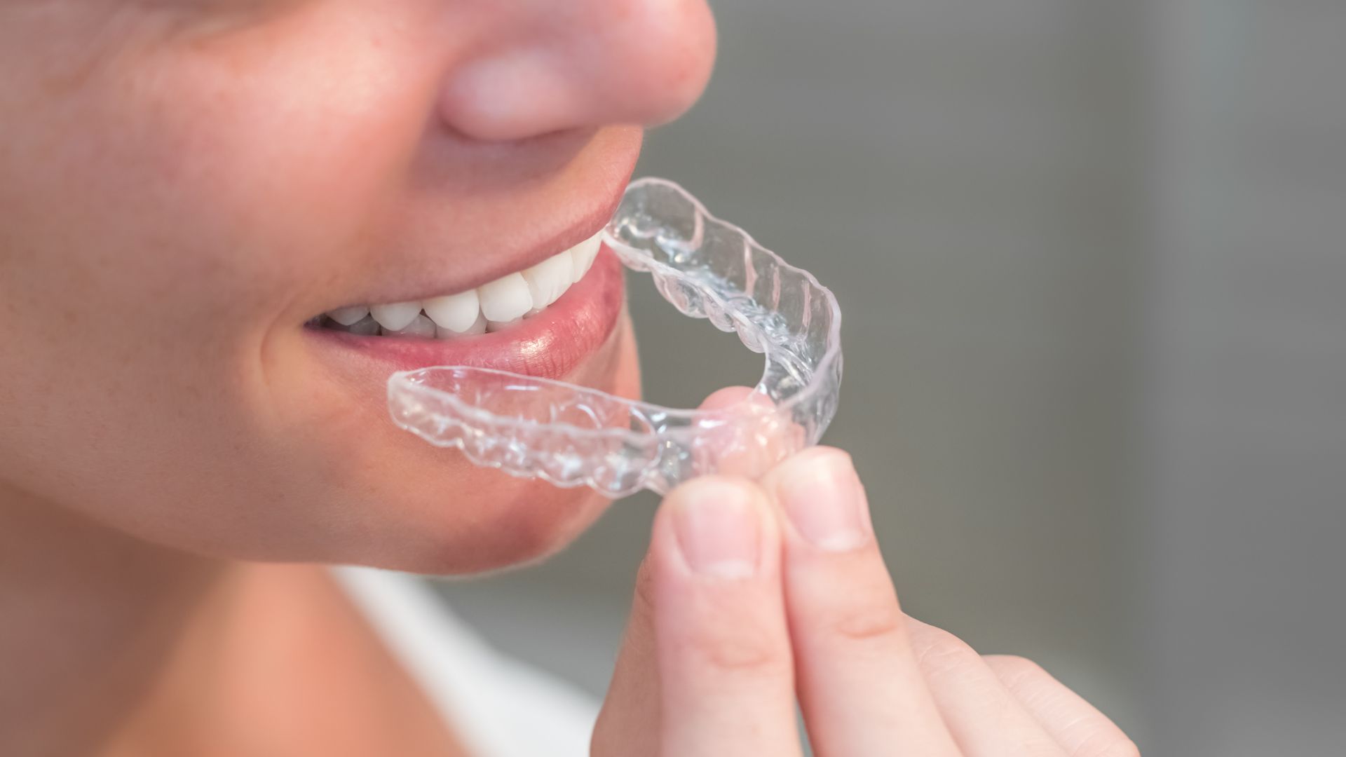 Descubra a diferença entre o aparelho dentário tradicional e o autoligado. Entenda como o fim das borrachinhas garante um tratamento mais rápido e confortável na Smile More Clinic.